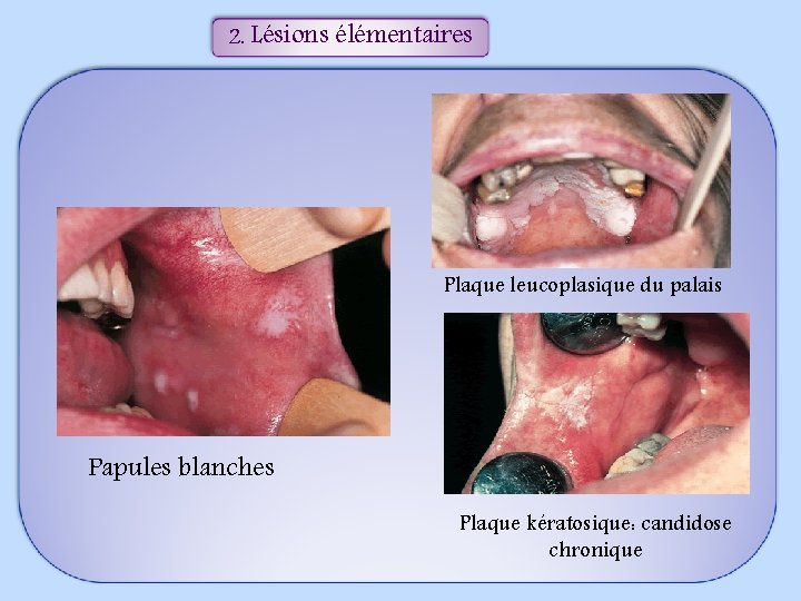 2. Lésions élémentaires Plaque leucoplasique du palais Papules blanches Plaque kératosique: candidose chronique 