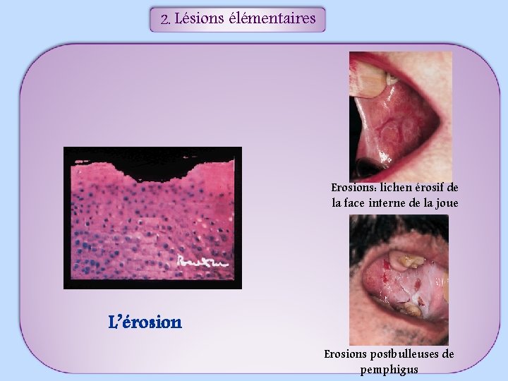 2. Lésions élémentaires Erosions: lichen érosif de la face interne de la joue L’érosion