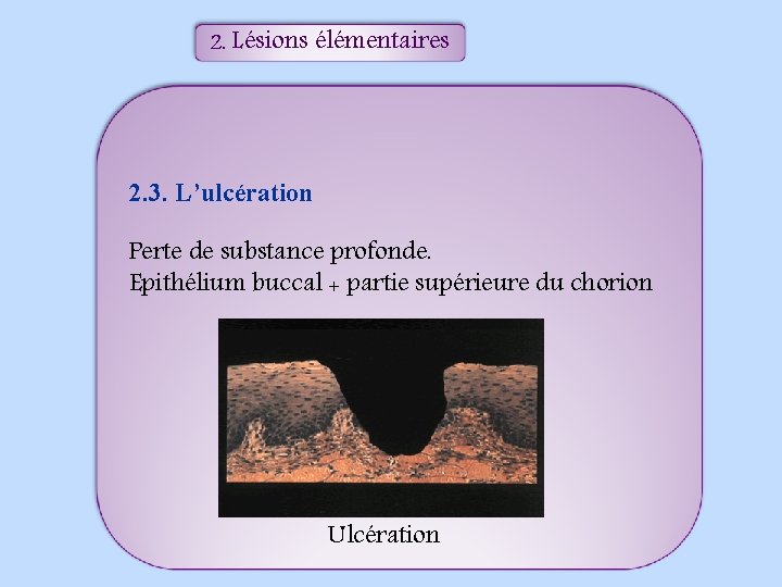 2. Lésions élémentaires 2. 3. L’ulcération Perte de substance profonde. Epithélium buccal + partie