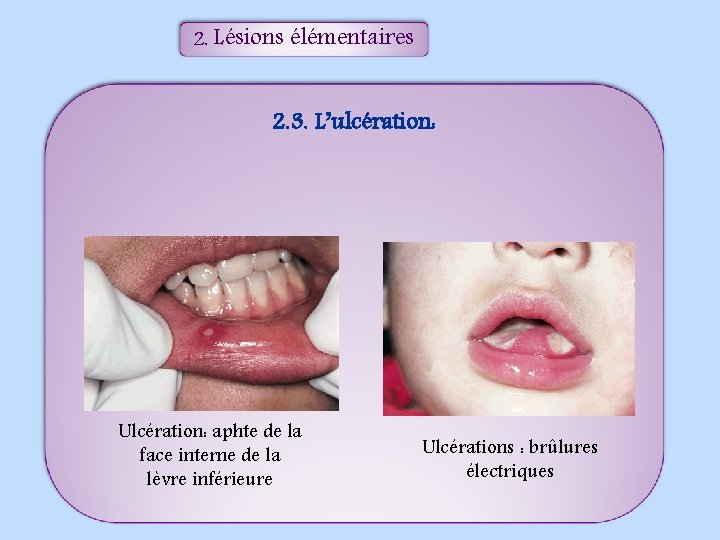 2. Lésions élémentaires 2. 3. L’ulcération: Ulcération: aphte de la face interne de la