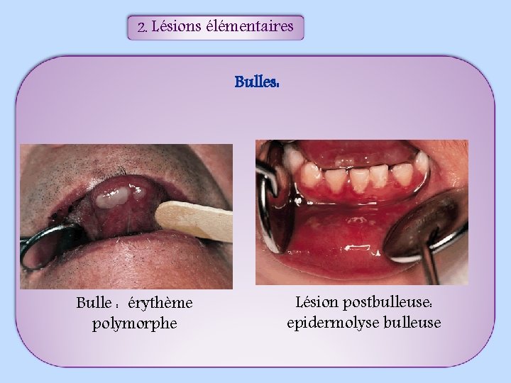 2. Lésions élémentaires Bulles: Bulle : érythème polymorphe Lésion postbulleuse: epidermolyse bulleuse 