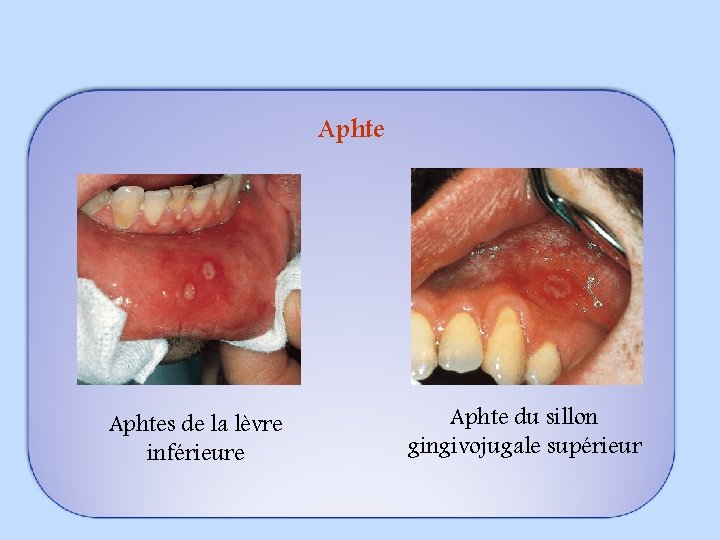 Aphtes de la lèvre inférieure Aphte du sillon gingivojugale supérieur 