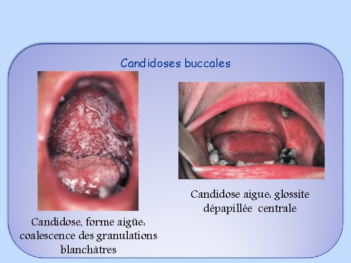 Candidoses buccales Candidose, forme aigüe: coalescence des granulations blanchâtres Candidose aigue: glossite dépapillée centrale