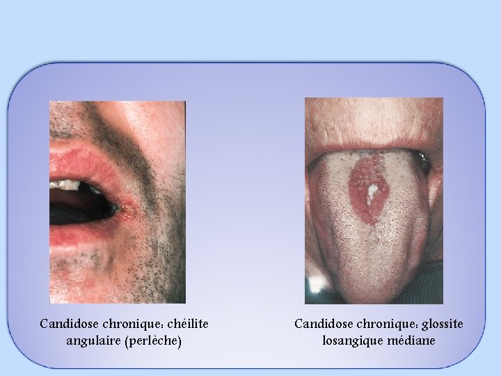 Candidose chronique: chéilite angulaire (perlèche) Candidose chronique: glossite losangique médiane 