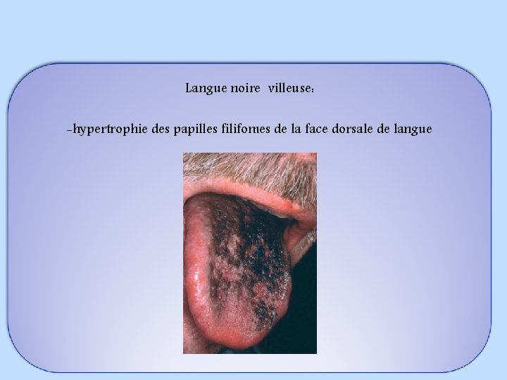 Langue noire villeuse: -hypertrophie des papilles filifomes de la face dorsale de langue 