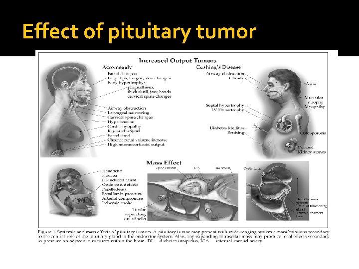 Effect of pituitary tumor 