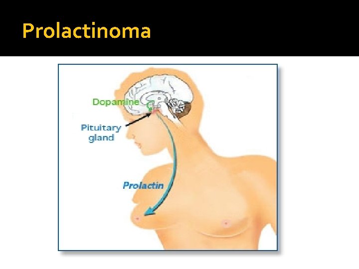 Prolactinoma 