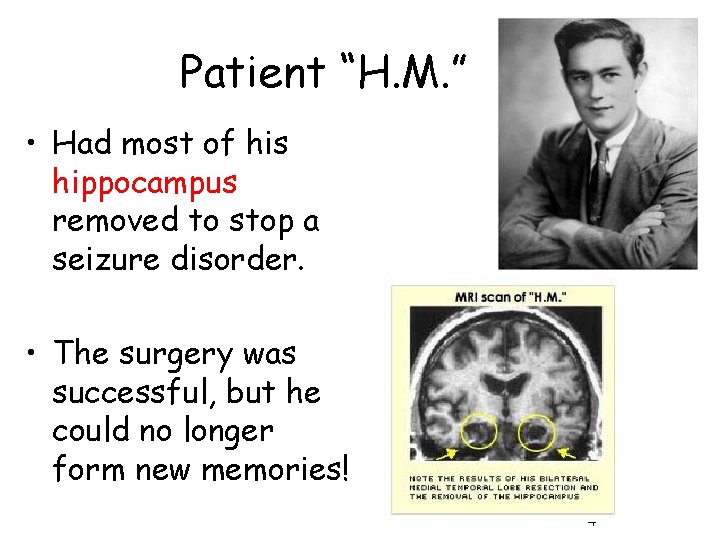 Patient “H. M. ” • Had most of his hippocampus removed to stop a