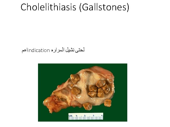 Cholelithiasis (Gallstones) ﺍﻫﻢ indication ﻟﺤﺘﻰ ﻧﺸﻴﻞ ﺍﻟﻤﺮﺍﺭﻩ 
