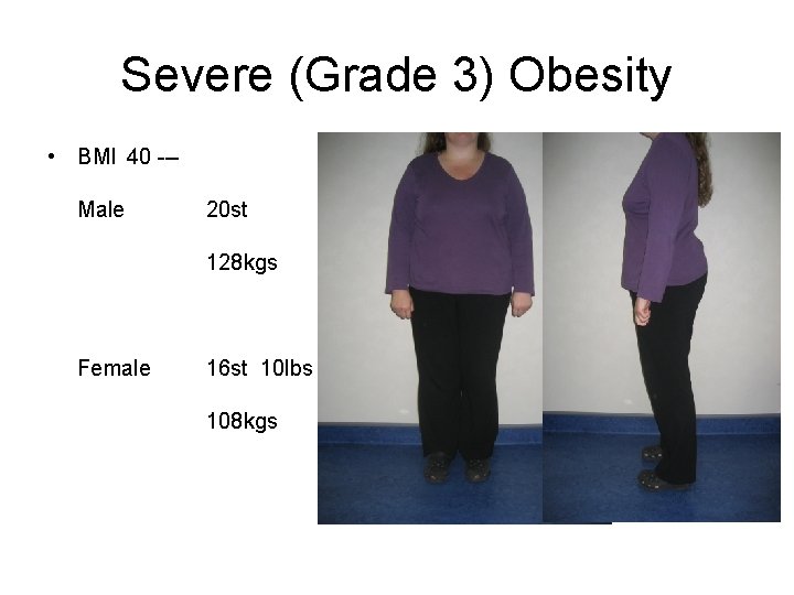 Severe (Grade 3) Obesity • BMI 40 --Male 20 st 128 kgs Female 16