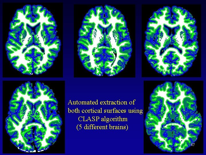 Automated extraction of both cortical surfaces using CLASP algorithm (5 different brains) 47 