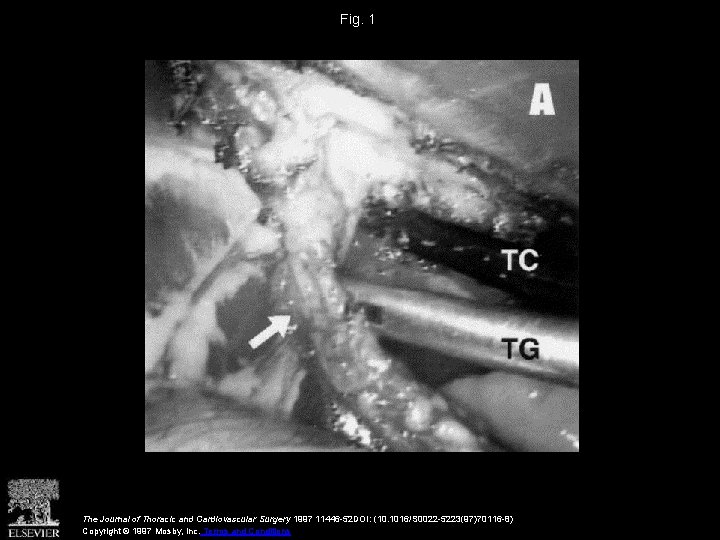 Fig. 1 The Journal of Thoracic and Cardiovascular Surgery 1997 11446 -52 DOI: (10.