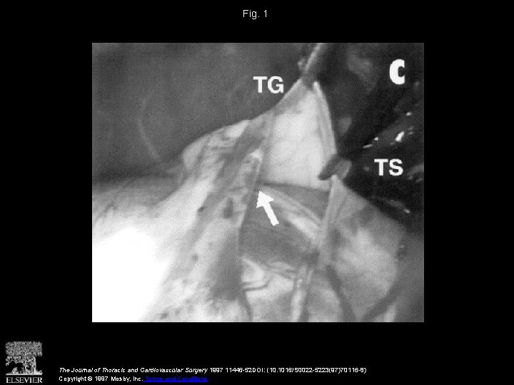 Fig. 1 The Journal of Thoracic and Cardiovascular Surgery 1997 11446 -52 DOI: (10.