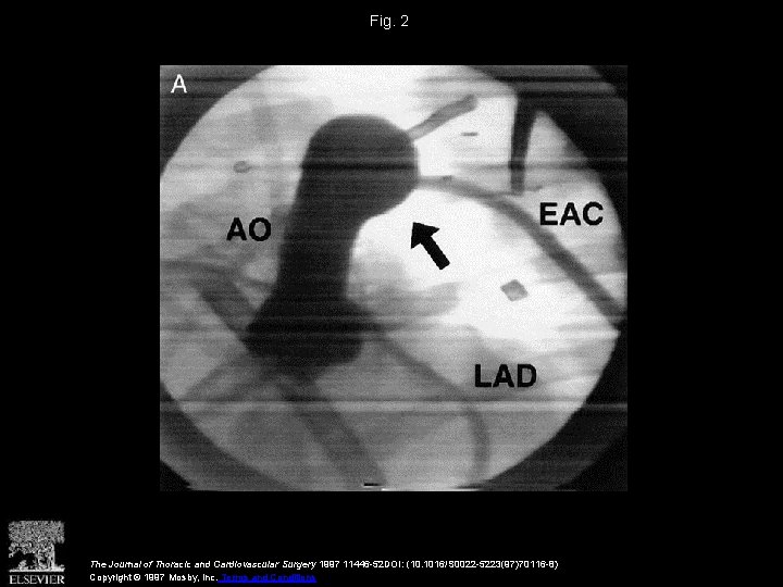 Fig. 2 The Journal of Thoracic and Cardiovascular Surgery 1997 11446 -52 DOI: (10.
