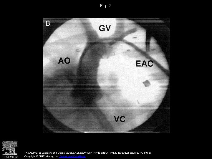 Fig. 2 The Journal of Thoracic and Cardiovascular Surgery 1997 11446 -52 DOI: (10.