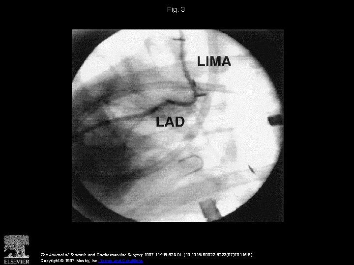 Fig. 3 The Journal of Thoracic and Cardiovascular Surgery 1997 11446 -52 DOI: (10.