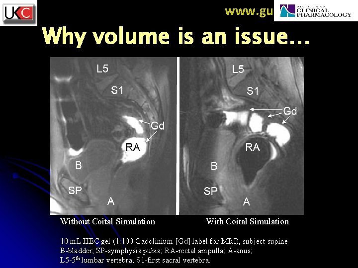 www. guscairns. com Why volume is an issue… Without Coital Simulation With Coital Simulation