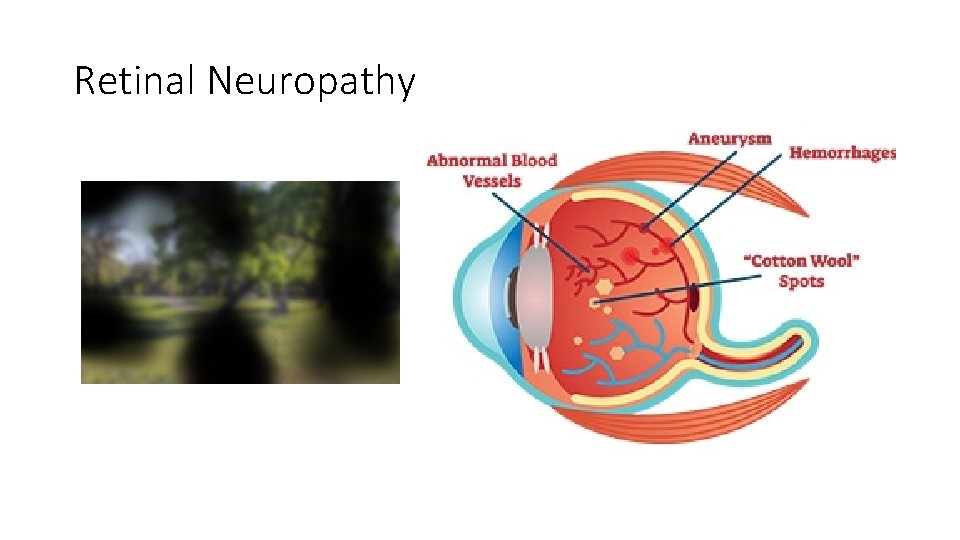 Retinal Neuropathy 