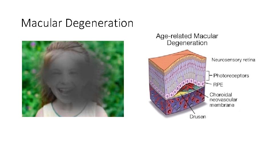 Macular Degeneration 