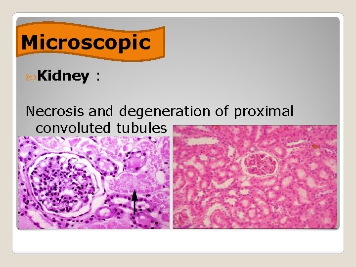 Microscopic Kidney : Necrosis and degeneration of proximal convoluted tubules 