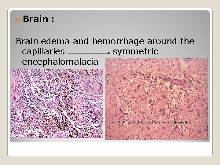  Brain : Brain edema and hemorrhage around the capillaries symmetric encephalomalacia 