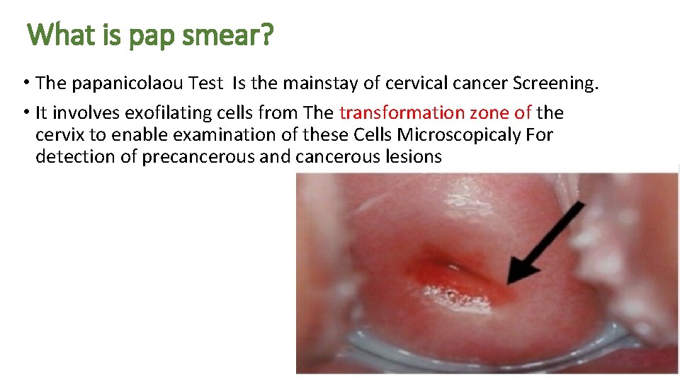 What is pap smear? • The papanicolaou Test Is the mainstay of cervical cancer
