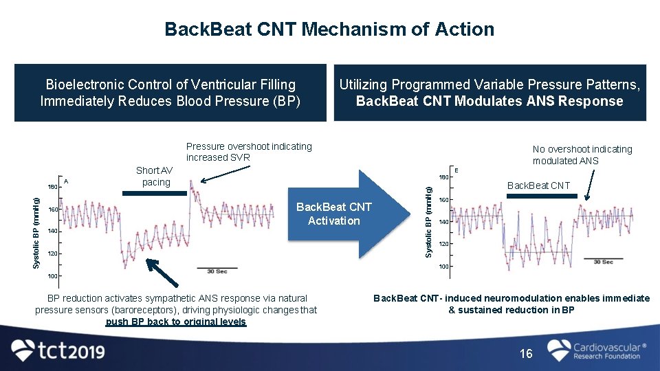 Back. Beat CNT Mechanism of Action Bioelectronic Control of Ventricular Filling Immediately Reduces Blood