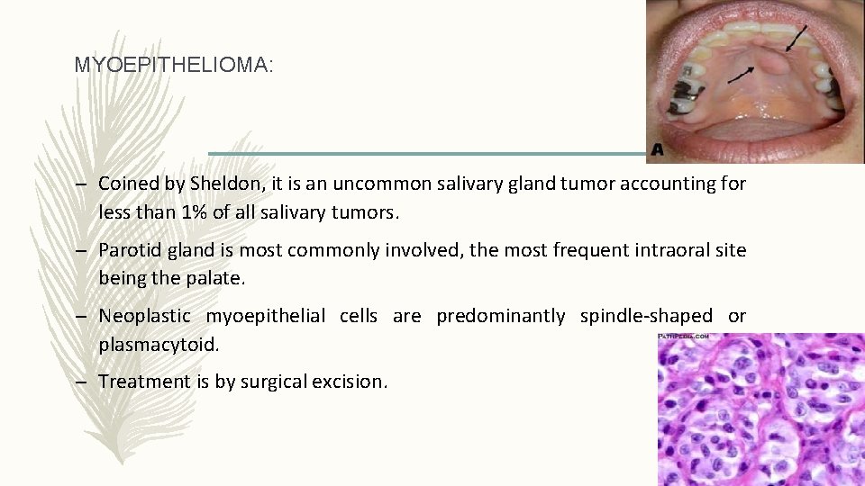 MYOEPITHELIOMA: – Coined by Sheldon, it is an uncommon salivary gland tumor accounting for