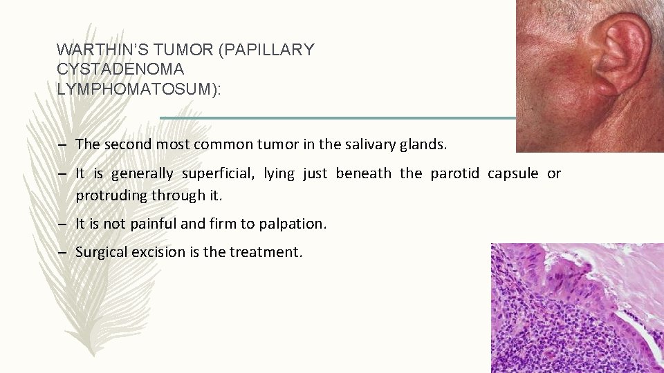 WARTHIN’S TUMOR (PAPILLARY CYSTADENOMA LYMPHOMATOSUM): – The second most common tumor in the salivary