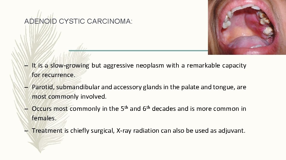 ADENOID CYSTIC CARCINOMA: – It is a slow-growing but aggressive neoplasm with a remarkable