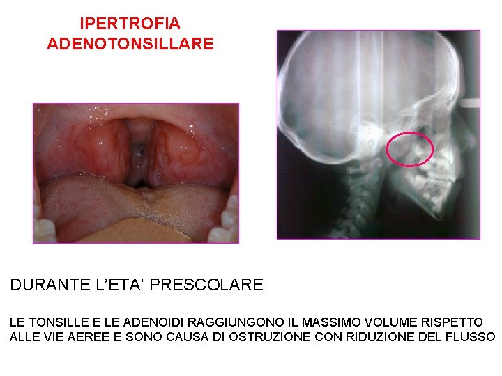 IPERTROFIA ADENOTONSILLARE DURANTE L’ETA’ PRESCOLARE LE TONSILLE E LE ADENOIDI RAGGIUNGONO IL MASSIMO VOLUME