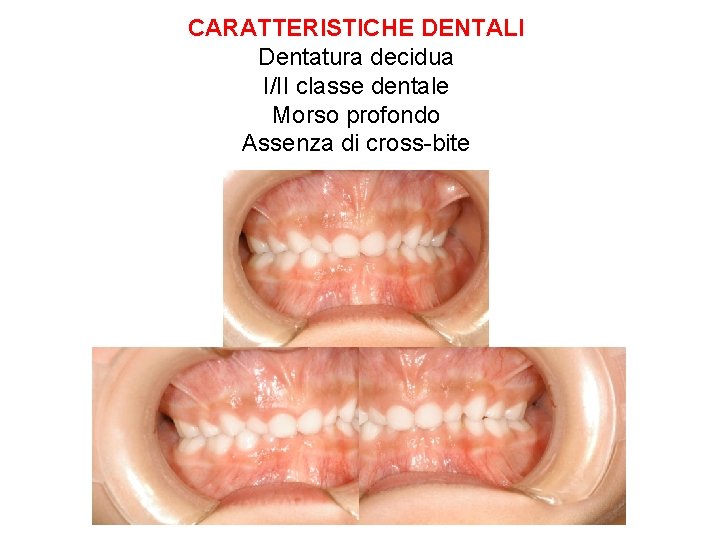 CARATTERISTICHE DENTALI Dentatura decidua I/II classe dentale Morso profondo Assenza di cross-bite 