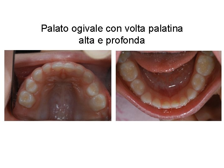 Palato ogivale con volta palatina alta e profonda 