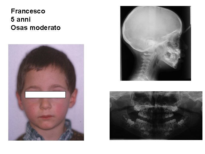 Francesco 5 anni Osas moderato 