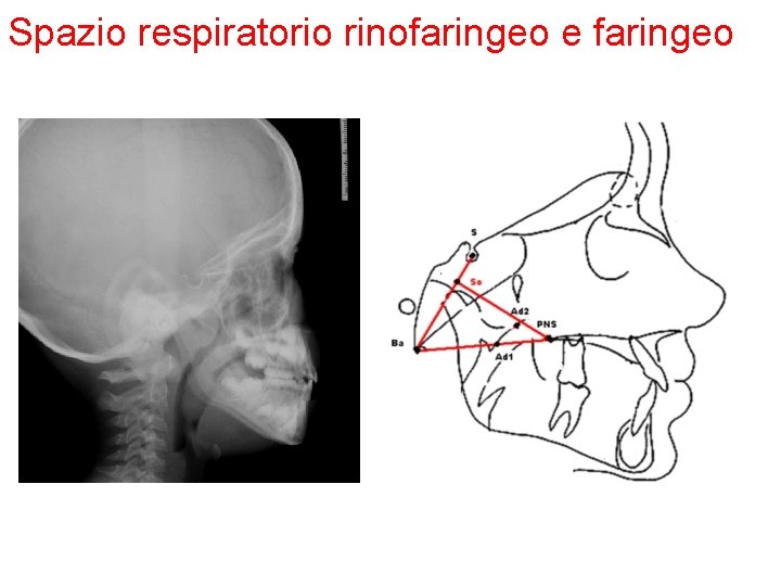 Spazio respiratorio rinofaringeo e faringeo 