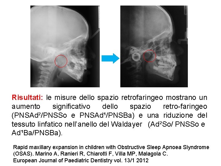 Risultati: le misure dello spazio retrofaringeo mostrano un aumento significativo dello spazio retro-faringeo (PNSAd²/PNSSo