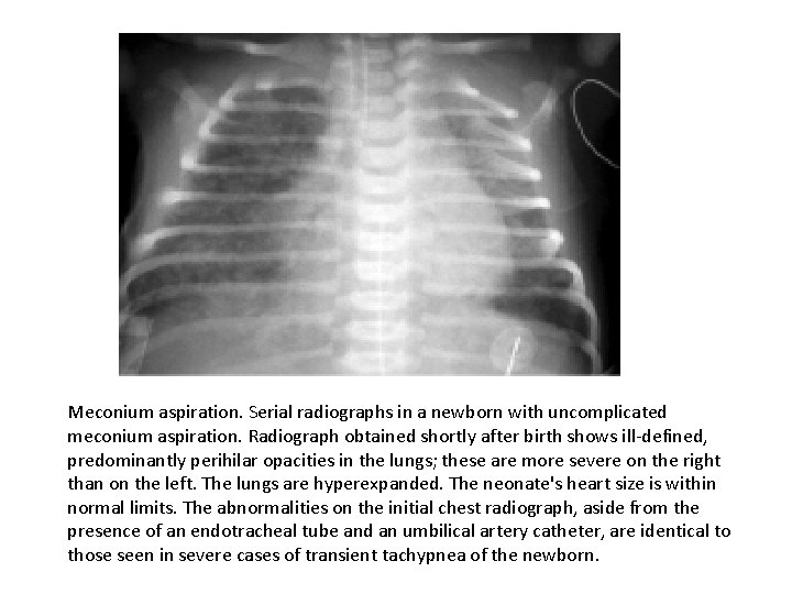 Meconium aspiration. Serial radiographs in a newborn with uncomplicated meconium aspiration. Radiograph obtained shortly