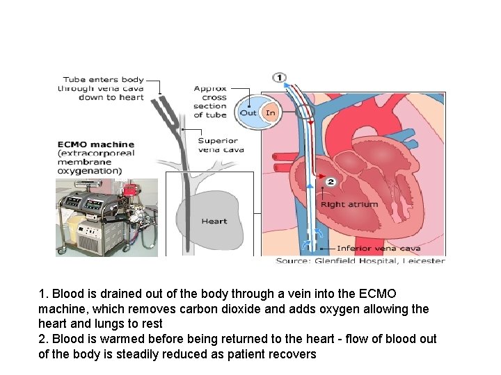 1. Blood is drained out of the body through a vein into the ECMO