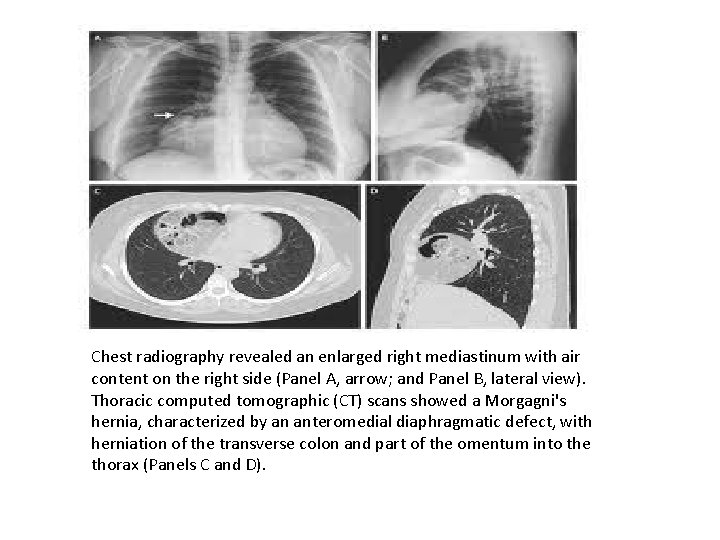 Chest radiography revealed an enlarged right mediastinum with air content on the right side