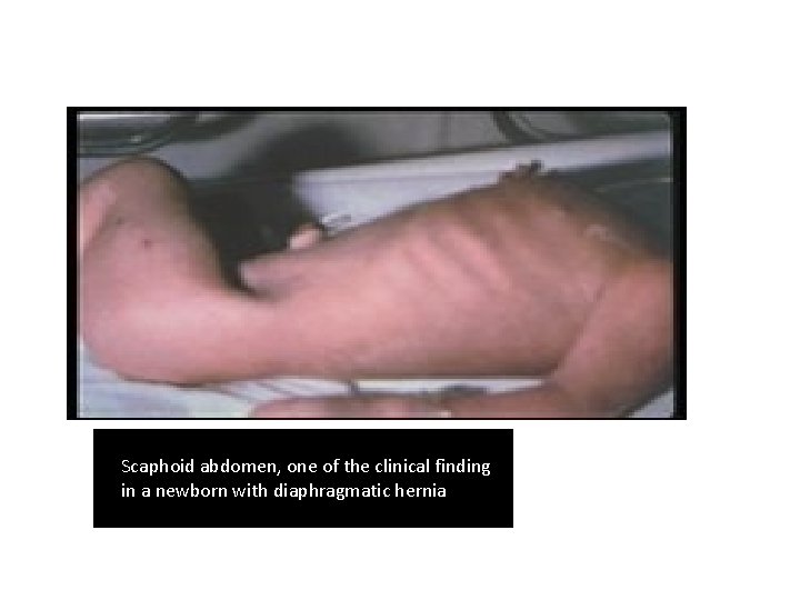 Scaphoid abdomen, one of the clinical finding in a newborn with diaphragmatic hernia 