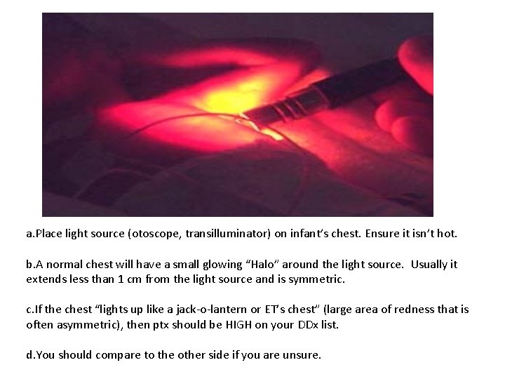 a. Place light source (otoscope, transilluminator) on infant’s chest. Ensure it isn’t hot. b.