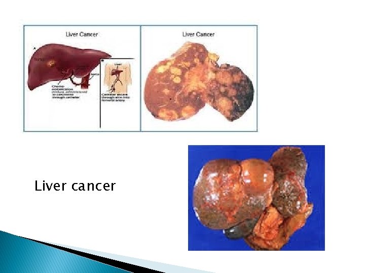 Liver cancer 