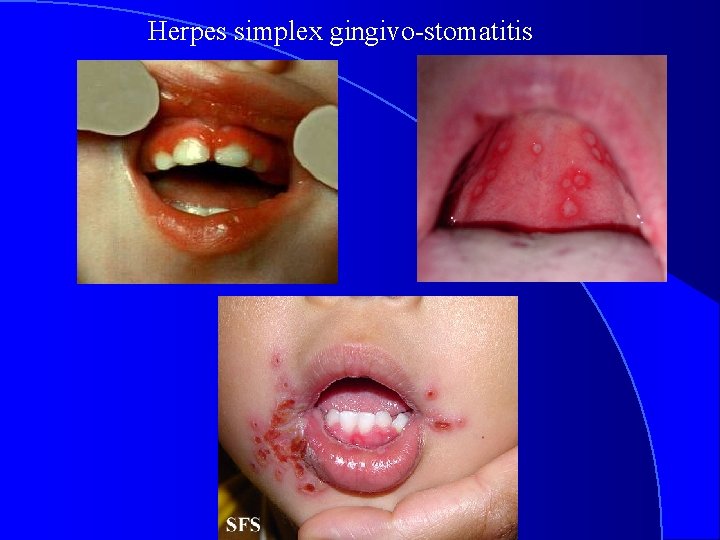 Herpes simplex gingivo-stomatitis 