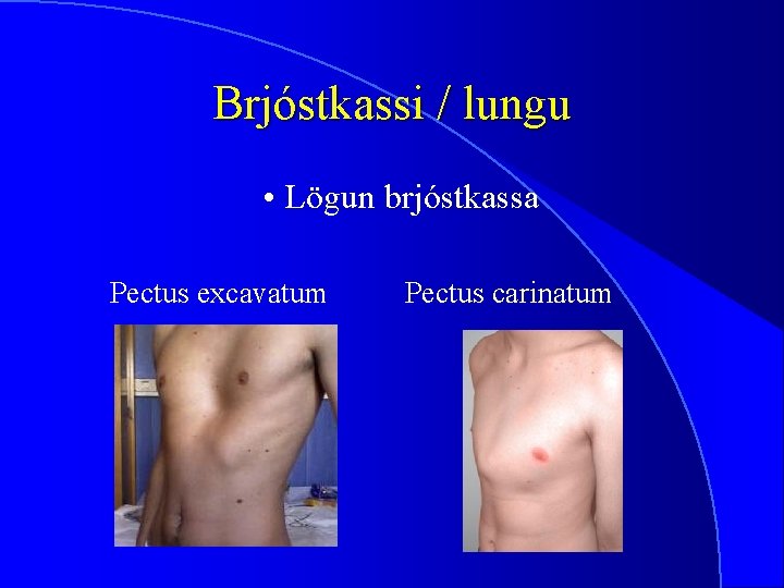 Brjóstkassi / lungu • Lögun brjóstkassa Pectus excavatum Pectus carinatum 