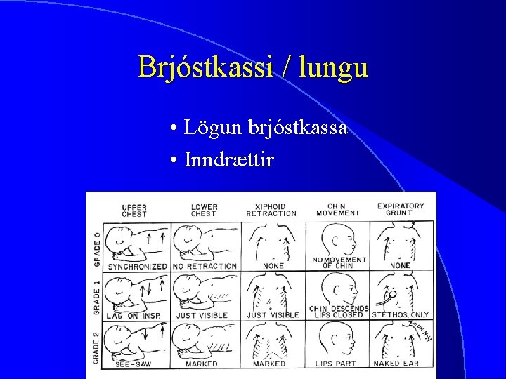 Brjóstkassi / lungu • Lögun brjóstkassa • Inndrættir 