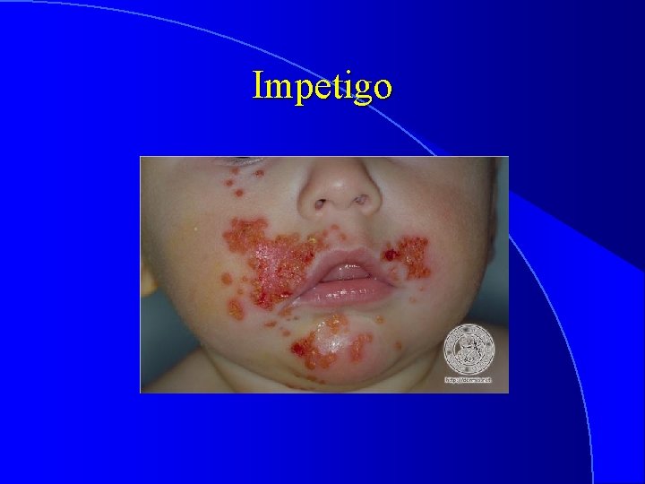 Impetigo 