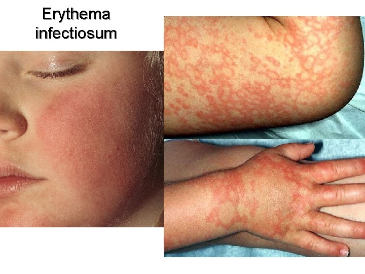 Erythema infectiosum 