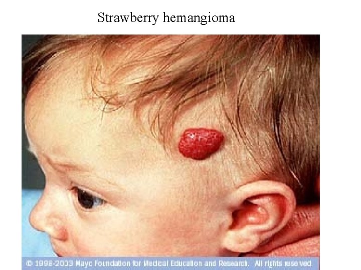 Strawberry hemangioma 