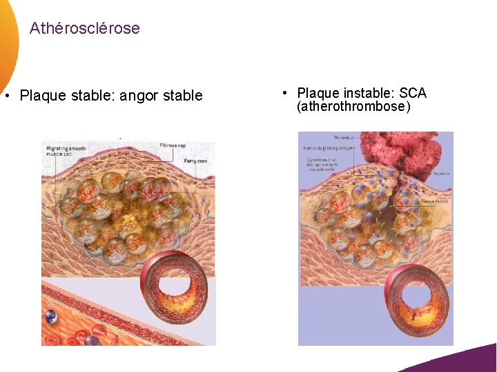 Athérosclérose • Plaque stable: angor stable • Plaque instable: SCA (atherothrombose) 