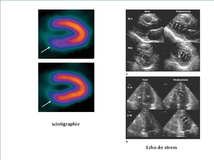 scintigraphie Echo de stress 33 